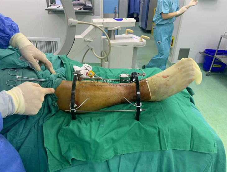 【望京醫(yī)院】不開刀治骨折病例分享——小腿骨折伴踝骨折